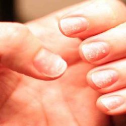 Home remedies for white spots on nails