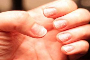 Home remedies for white spots on nails