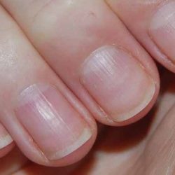 Ridged nails: care and treatment